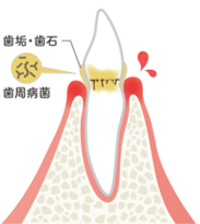 歯肉炎