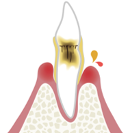 歯周炎(中度)