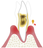歯周炎(重度)
