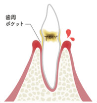 歯周炎(軽度)